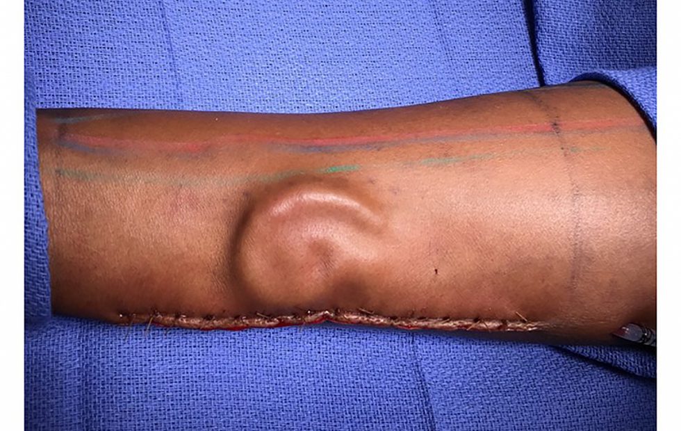 Usai Dioperasi, Tentara Ini Punya Telinga Pengganti di Lengan