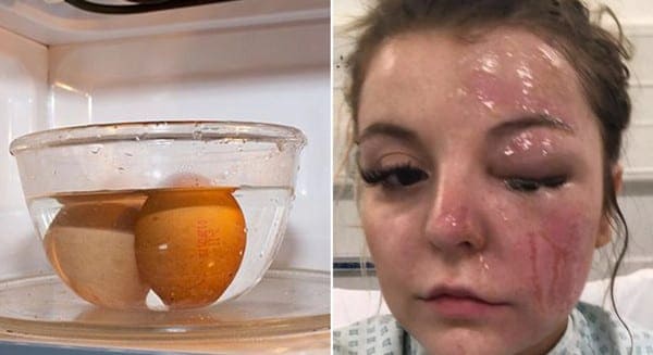 Ikuti Tips YouTube, Wanita Ini Jadi Korban ‘Telur Meledak’