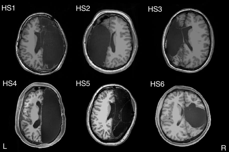 hidup dengan separuh otak