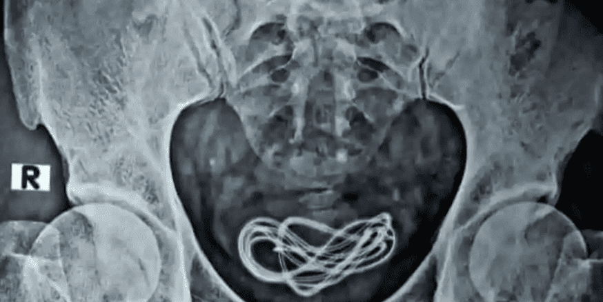 Kabel Charger Kandung Kemih