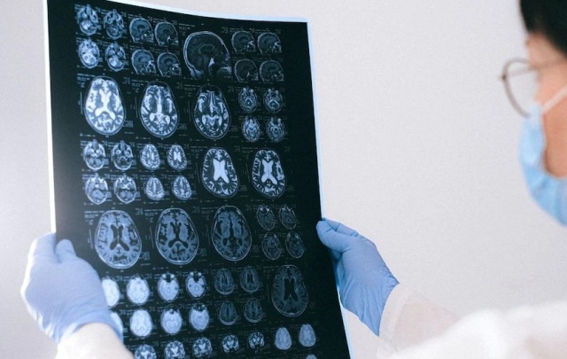 obat gejala Alzheimer