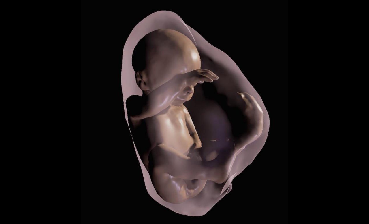 Virtual Reality bayi kembar Siam