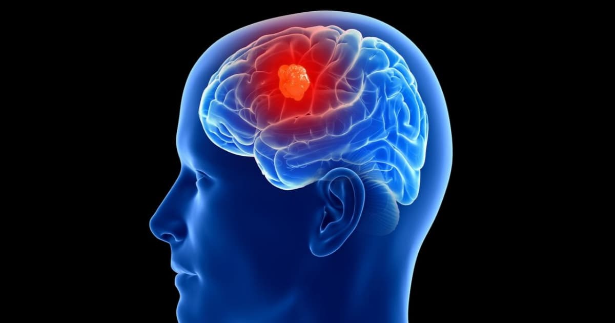 Ilustrasi implan otak Coherence Neuro untuk pengobatan tumor glioblastoma