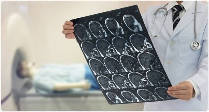 Prediksi Risiko Stroke: Peneliti Kembangkan Perangkat Arteri pada Cip
