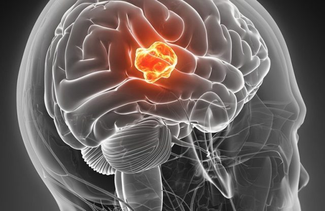 Nanopartikel Karya Peneliti Bantu Membunuh Sel Kanker Otak