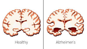 Telur dan AI: Cara Tak Terduga Sembuhkan Alzheimer